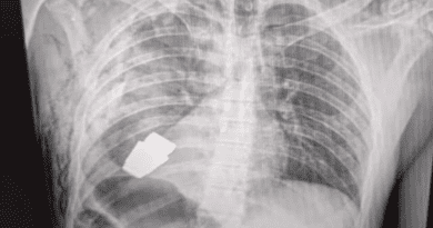The X-Ray of the grenade